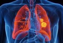 ਫੇਫੜਿਆਂ ਦੇ ਕੈਂਸਰ ਤੋਂ ਬਚਾਅ ਲਈ ਜਾਗਰੂਕਤਾ ਮਹੱਤਵਪੂਰਨ, ਮਾਹਿਰਾਂ ਨੇ ਸ਼ੁਰੂਆਤੀ ਪਛਾਣ ਅਤੇ ਸਮੇਂ ਸਿਰ ਇਲਾਜ ‘ਤੇ ਜ਼ੋਰ ਫੇਫੜਿਆਂ ਦੇ ਕੈਂਸਰ ਤੋਂ ਬਚਾਅ ਲਈ ਜਾਗਰੂਕਤਾ ਮਹੱਤਵਪੂਰਨ, ਮਾਹਿਰਾਂ ਨੇ ਸ਼ੁਰੂਆਤੀ ਪਛਾਣ ਅਤੇ ਸਮੇਂ ਸਿਰ ਇਲਾਜ ‘ਤੇ ਜ਼ੋਰ