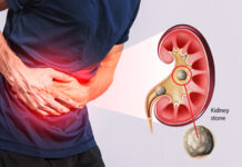 ਸਰਦੀਆਂ ‘ਚ ਵਧਦਾ ਹੈ ਗੁਰਦੇ ਦੀ ਪੱਥਰੀ ਦਾ ਖਤਰਾ