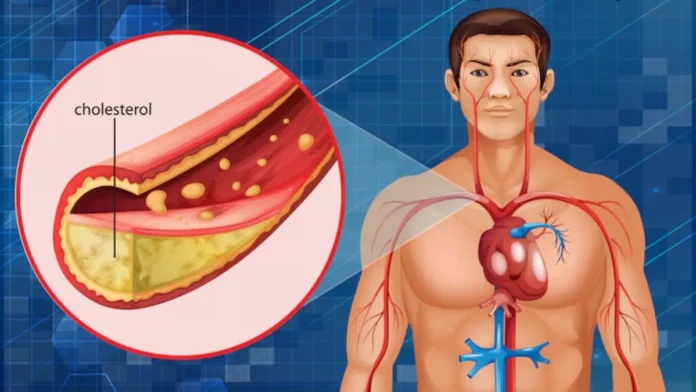 high-cholesterol-1744135665