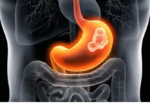 ਪੇਟ ਦੇ ਕੈਂਸਰ ਦੇ ਇਹ 5 ਲੱਛਣ ਰਹਿ ਨਾ ਜਾਣ—ਅਣਡਿੱਠੀ ਕਰਨਾ ਹੋ ਸਕਦਾ ਹੈ ਘਾਤਕ