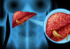 Fatty Liver Day 2026: ਫੈਟੀ ਲਿਵਰ ਤੋਂ ਲਿਵਰ ਕੈਂਸਰ ਦਾ ਖਤਰਾ, ਡਾਕਟਰਾਂ ਨੇ ਦੱਸੇ ਬਚਾਅ ਦੇ ਤਰੀਕੇ