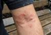 Skin Infection: ਬਰਸਾਤ ਵਿੱਚ ਇਨ੍ਹਾਂ 5 ਗਲਤੀਆਂ ਕਾਰਨ ਵੱਧ ਸਕਦੈ ਸਕਿਨ ਇਨਫੈਕਸ਼ਨ, ਜਾਣੋ ਬਚਾਅ ਦੇ ਤਰੀਕੇ