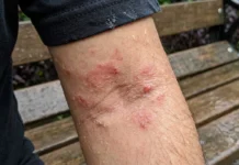 Skin Infection: ਬਰਸਾਤ ਵਿੱਚ ਇਨ੍ਹਾਂ 5 ਗਲਤੀਆਂ ਕਾਰਨ ਵੱਧ ਸਕਦੈ ਸਕਿਨ ਇਨਫੈਕਸ਼ਨ, ਜਾਣੋ ਬਚਾਅ ਦੇ ਤਰੀਕੇ
